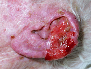 High-risk squamous cell carcinoma