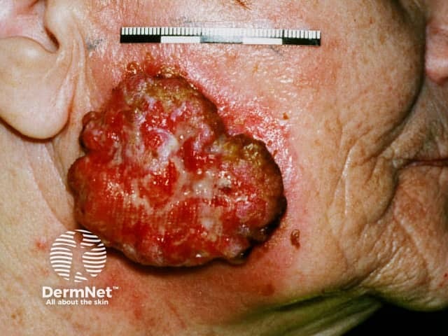 Advanced squamous cell carcinoma