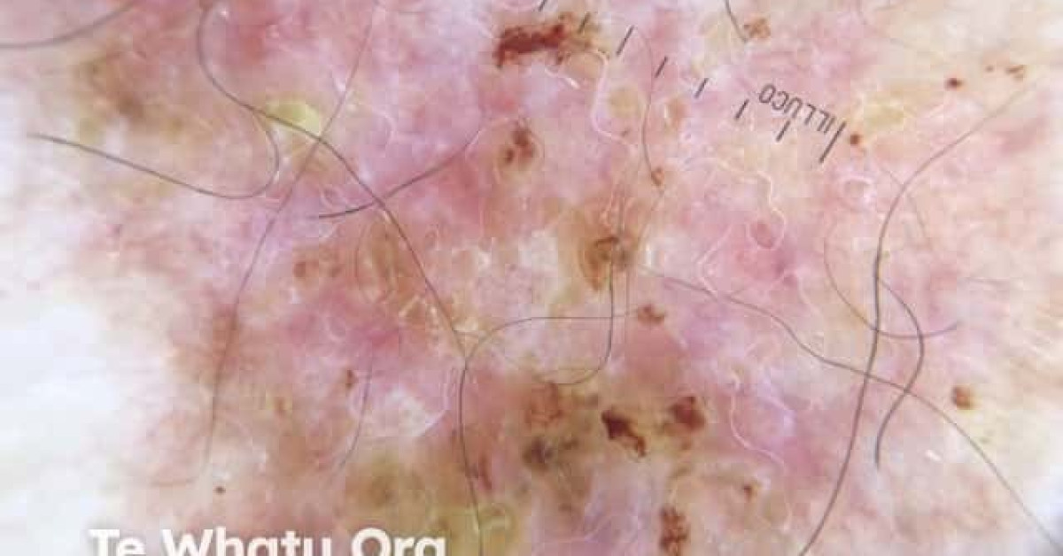 Squamous Cell Carcinoma In Situ