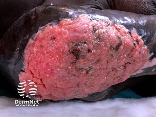 Advanced squamous cell carcinoma arising in thermal burn scar