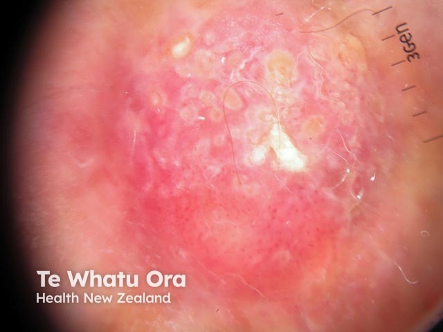 White circles and surface keratin seen in squamous cell carcinoma dermoscopy