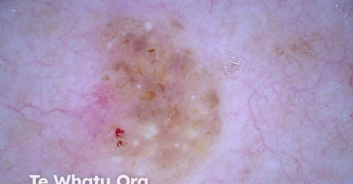 DermNet® - Seborrhoeic keratosis, nonpolarised dermoscopy view image