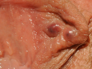 Vulval sebaceous adenitis
