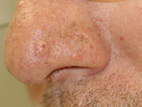 Sebaceous adenoma in patient with Lynch syndrome