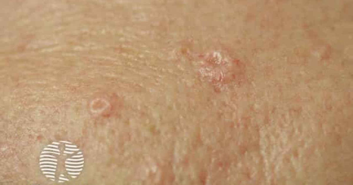 Sebaceous hyperplasia image