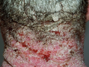 Severe psoriasis scalp and neck