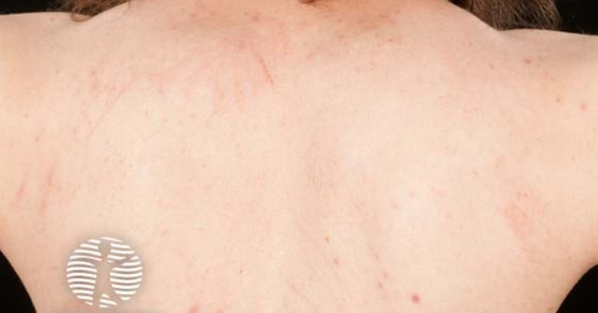 Shiitake flagellate dermatitis image