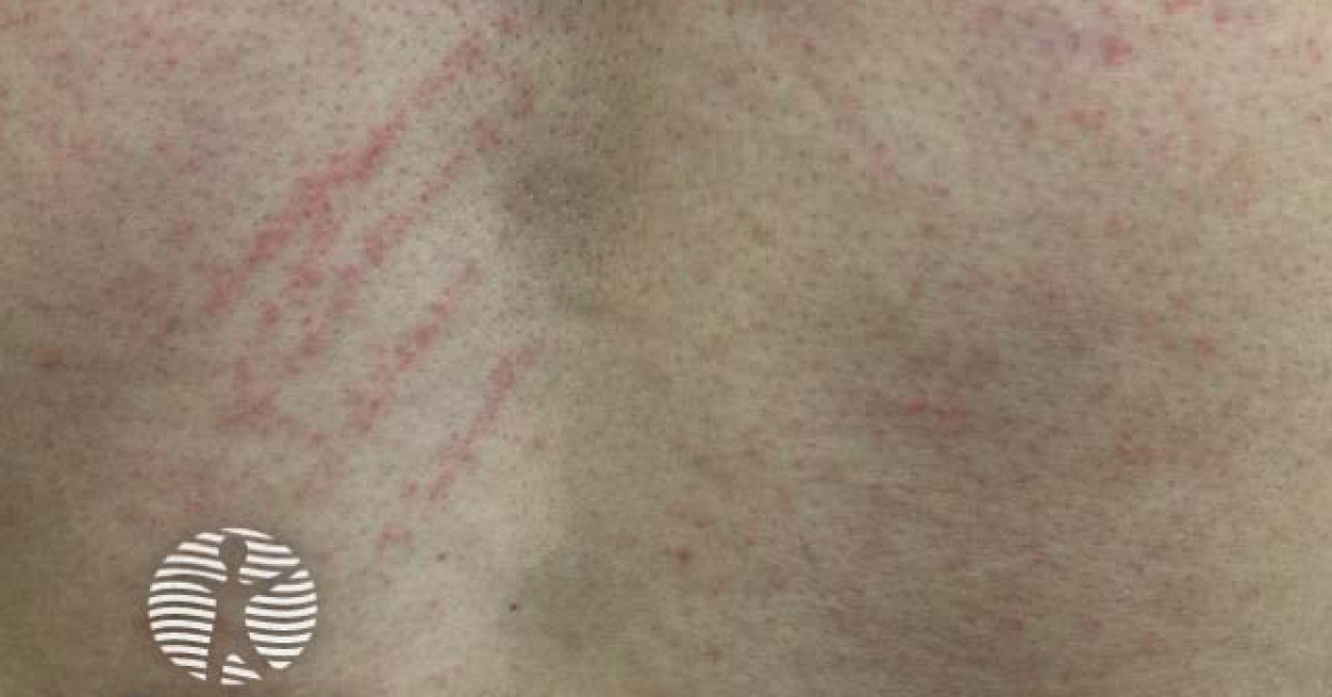 Shiitake flagellate erythema image