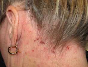 Atopic dermatitis of scalp