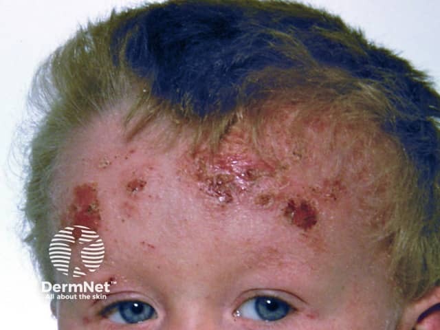 Atopic dermatitis of scalp