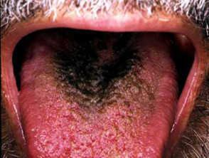 Hairy Tongue Dermnet Nz