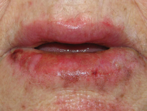 eczema by mouth