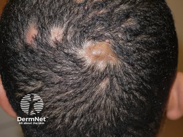 Perifolliculitis Of Scalp Perifolliculitis Of Scalp