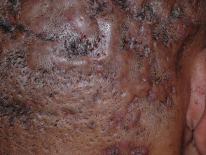 Dissecting cellulitis