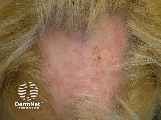 Discoid lupus erythematosus of scalp