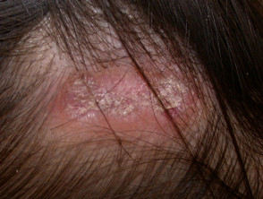 Discoid lupus erythematosus of scalp