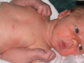 Toxic erythema of the newborn