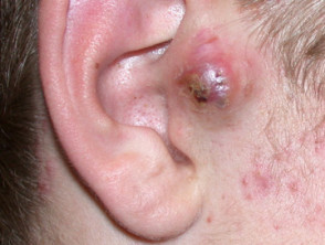 infected sebaceous cyst behind ear