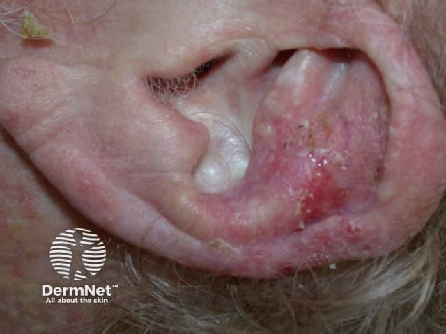 Basal cell carcinoma, ill-defined
