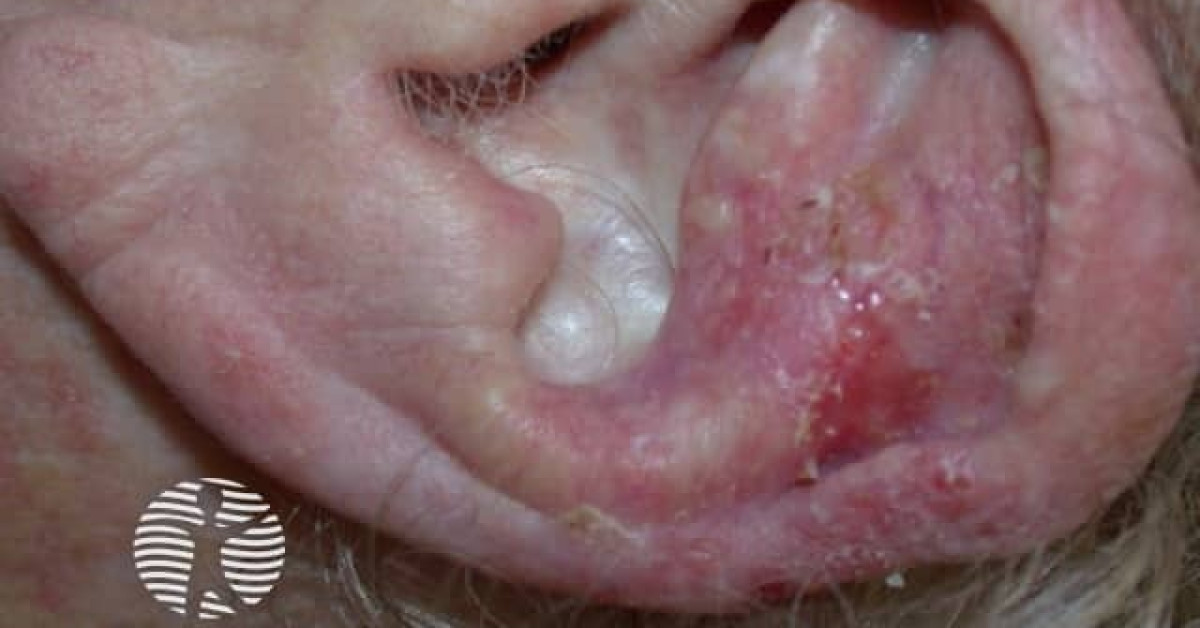 Basal cell carcinoma illdefined image