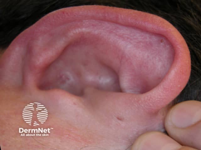 Pre-auricular sinus