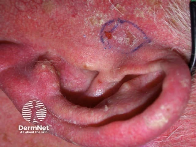 Squamous basal cell carcinoma