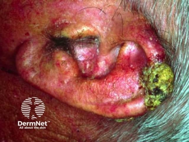 Squamous cell carcinoma