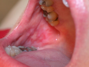 Erosive oral lichen planus