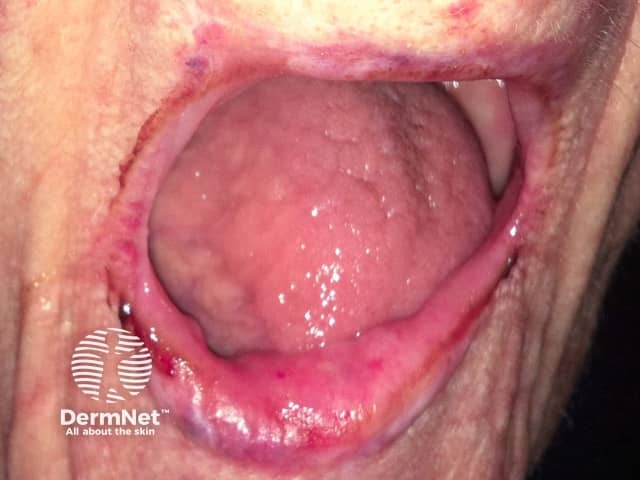 Eosinophilic ulcer of the lip