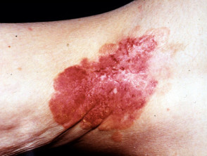 Extramammary Paget disease