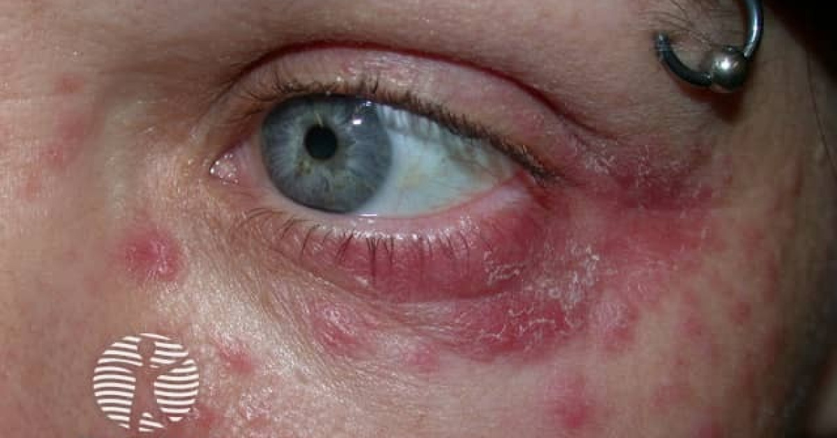 Periocular/periorificial Dermatitis Image