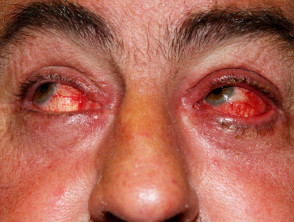 Eyelid infected eczema