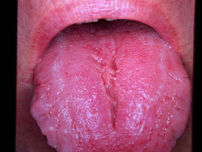 Fissured tongue