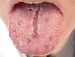 Middle of tongue split in Loftus Plastic