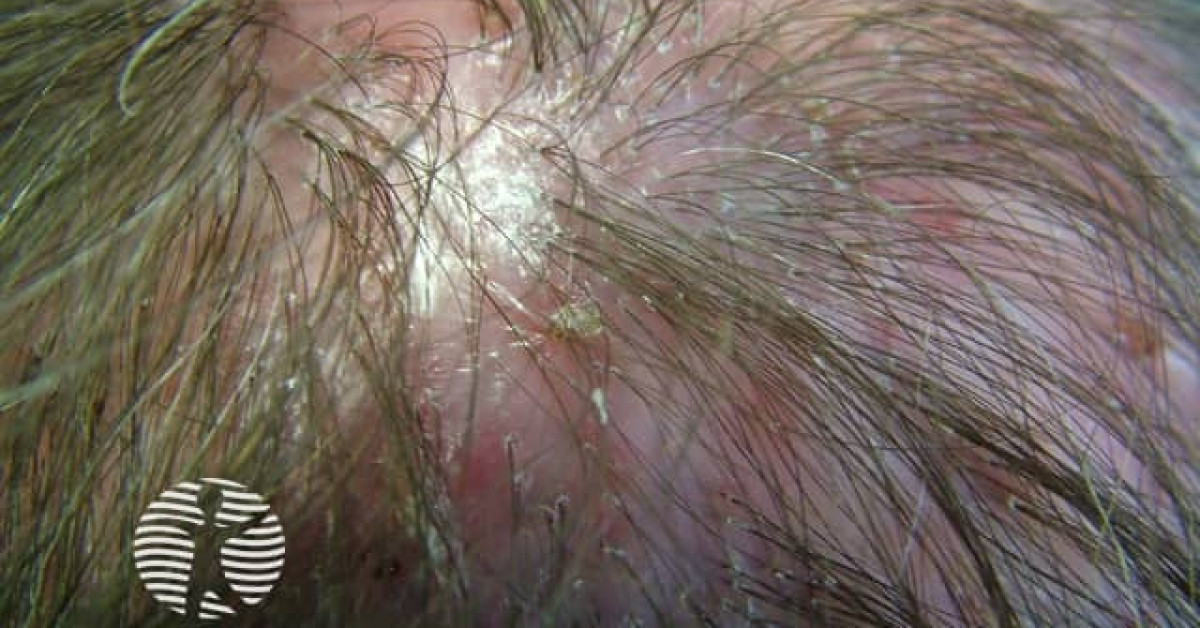 Folliculitis decalvans image