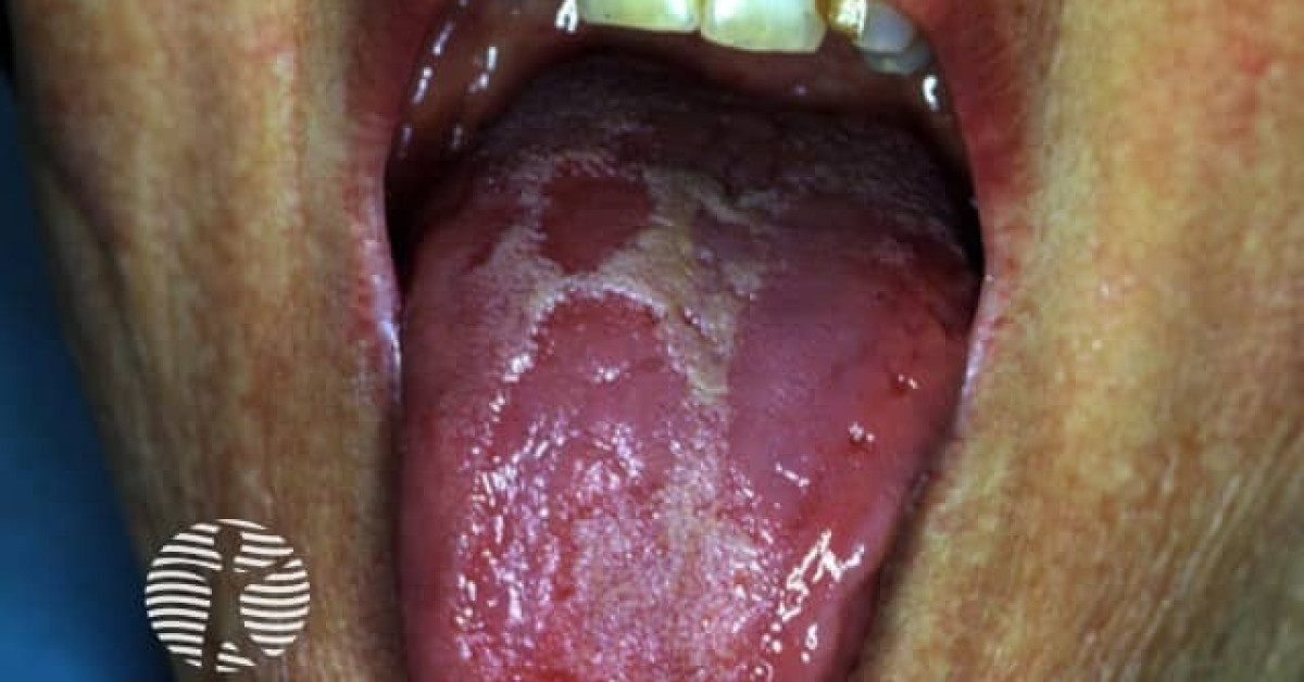 Geographic tongue image