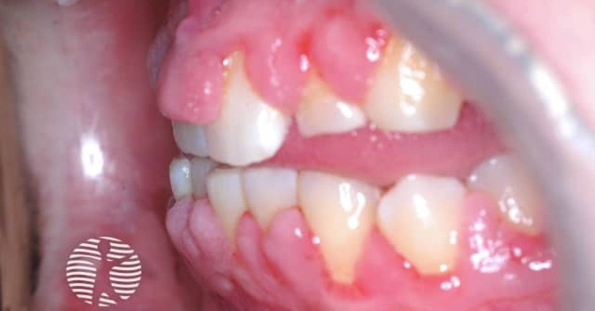 Gingival Hyperplasi Med Tannregulering Histological Section Showing