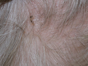 lice infestation