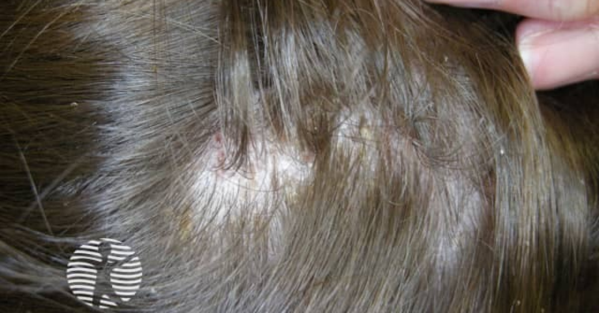 Head lice image