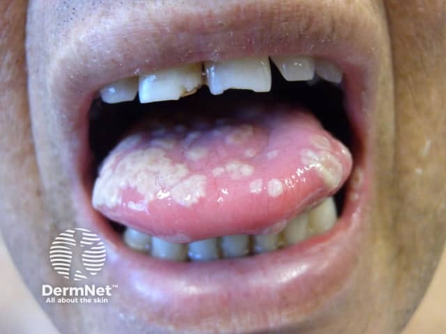 Severe herpes simplex infection