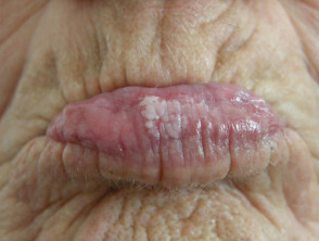 Лейкоплакия губы фото