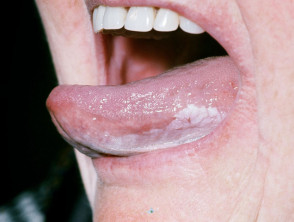 Oral leukoplakia