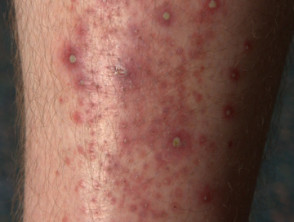 itchy rash on lower legs