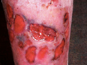 Leg ulcers