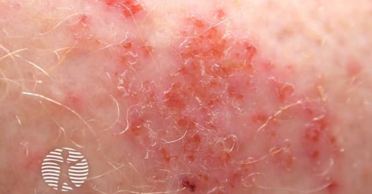 Discoid dermatitis image