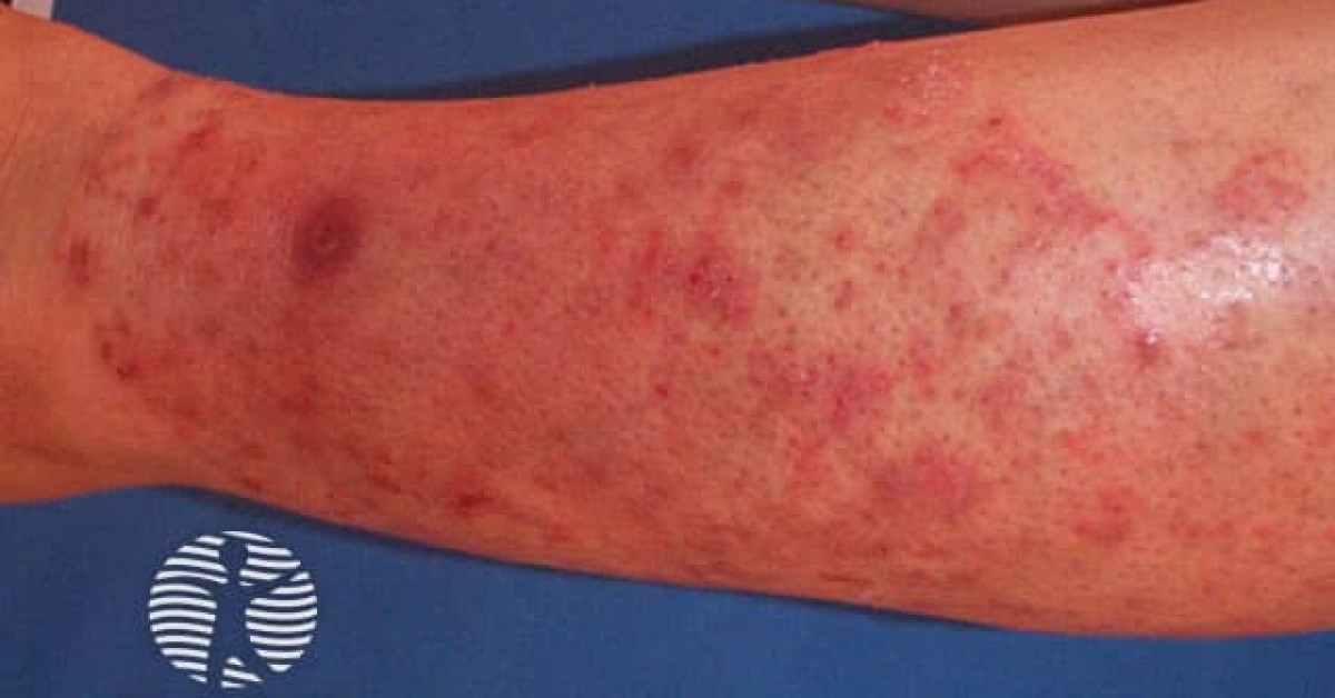 Tinea corporis image