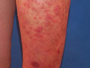 Lower leg rashes