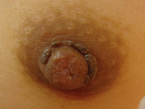 Hyperkeratosis of nipple