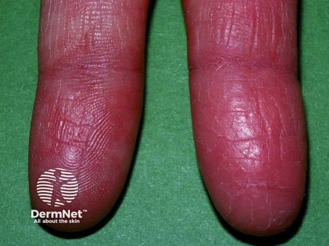 Reduced fingerprint due to dermatitis
