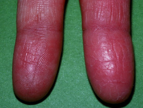 Reduced fingerprint due to dermatitis